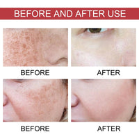 Siyinzu Dark Spot Correcting Glow Serum,5% Niacinamide Serum,Brightening Dark Spot Ser/um,Dar/k Spo/t Remover for Face,Anti-Aging Ser/um,Hydrating Facial Se/rum,Skin Care S/erum for Age/Sun Spots/Acne Marks