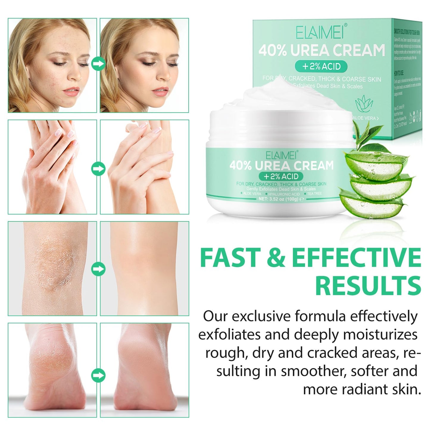 Urea Cream 40 Percent, Urea Foot & Hand Cream for Dry Cracked, 40 per Urea Lotion for Feet-100g