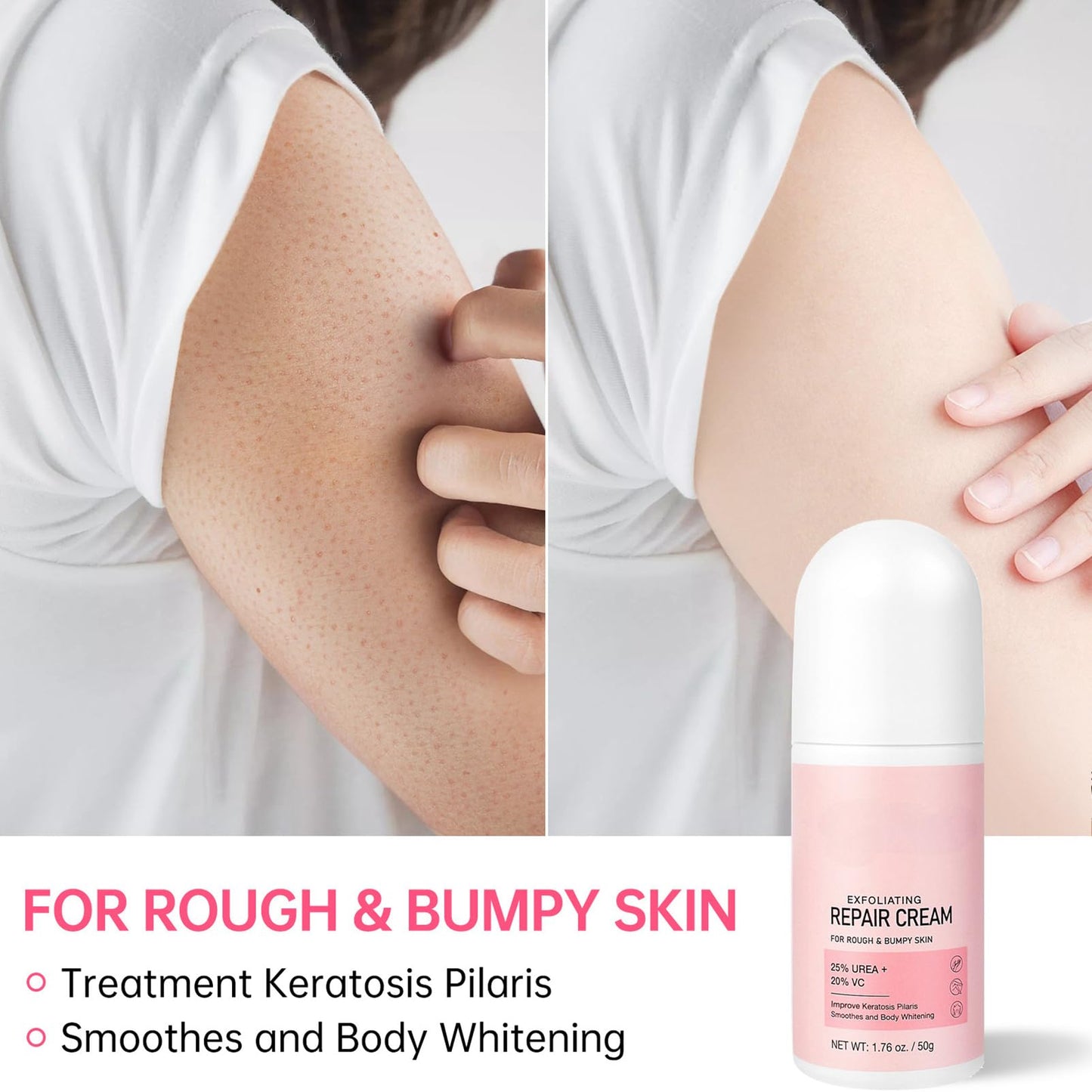 MEITREND Strawberry Skin Treatment,Skin Exfoliating Repair Cream with 20% Vitamin C and 25% Urea,Strawberry Legs Treatment Rough Bumpy Skin Body Lotion Moisturizing Cream,Chicken Skin Care Cream