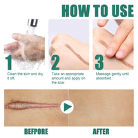 Jinjiar Scar Removal Set with Repair Scar Cream & Serum,Scar Removal Cream,Scar Treatment,Advanced Scar Gel for Old and New Scars,Scar Crea-m After Surgery,S-car Healing Cre-am,Acne Sc-ar Treatment,Scar Away
