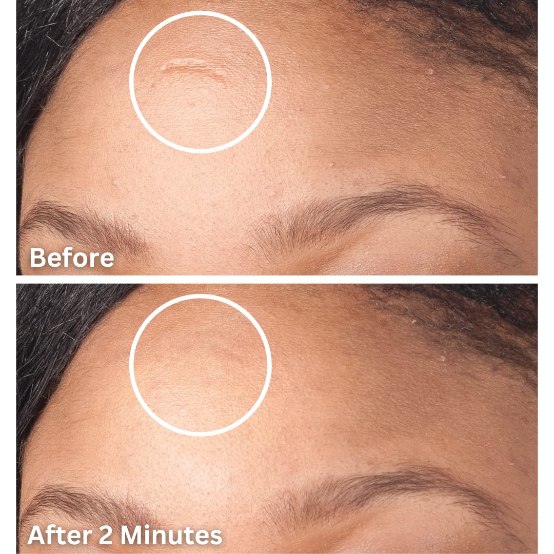 Dermaflage Scar Filler, Refill Applicator
