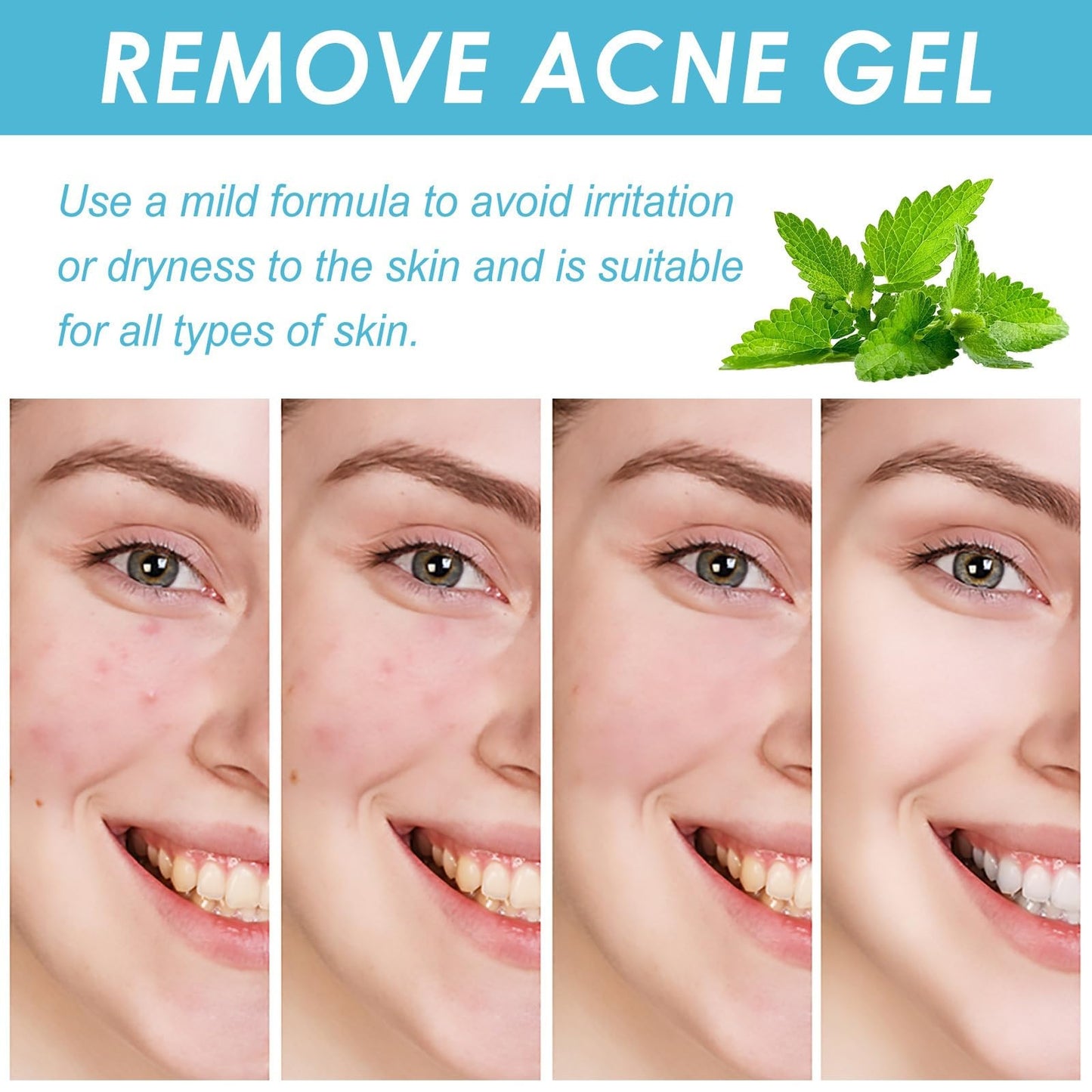 Acne Control Cream for Face,Face Serum for Acne Treatment,Acne Gel Fast Absorbing Spot Treatment,Fast Acting Spot Treat/ment for Fa/ce,Fungal Acn/e Treatm/ent for Women,Gel for Sp/ot Prone Skin