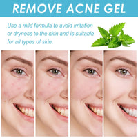 Acne Control Cream for Face,Face Serum for Acne Treatment,Acne Gel Fast Absorbing Spot Treatment,Fast Acting Spot Treat/ment for Fa/ce,Fungal Acn/e Treatm/ent for Women,Gel for Sp/ot Prone Skin