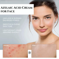 Jinjiar Aze-laic Ac-id 10% Facial Serum,Aze-laic Ac-id Cream for Face,Face Serum for Women,Az-elaic Aci-d Cream Gel,Hydrating Face Cream,Night Moisturiser,Face Cre-am,Night Cr-eam,Fa-ce Care,Skinoren Cre-am