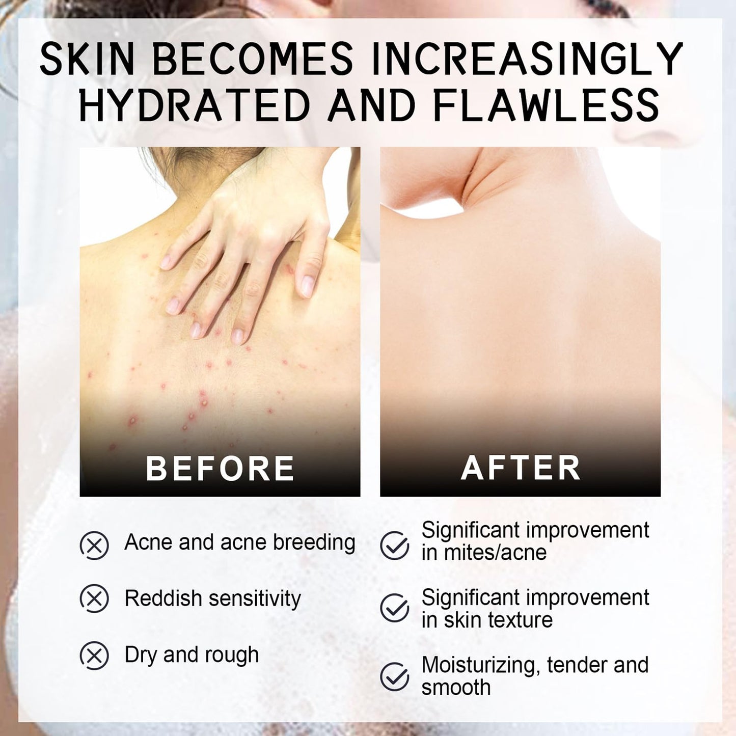 DMQ Acne Treatment Spary,Back Acne Treatment Serum,Body Moisturiser For Acne,Body Moisturiser For Dry Skin,Acne Moisturiser,Reduce Back Acne & Body Acne,Smoothing Moisturiser For Acne Prone Skin-120ml