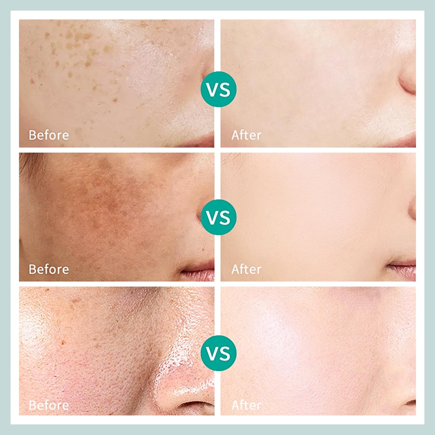 Yunnan Herbal Melasma Cream, Dark Spot Remover for Face Spot Cream, Freckle Removal Cream with Arbutin Niacinamide, Sun Spots, Freckles, Blemish Melasma Treatment for Face Cream, 20g