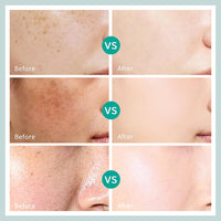 Yunnan Herbal Melasma Cream, Dark Spot Remover for Face Spot Cream, Freckle Removal Cream with Arbutin Niacinamide, Sun Spots, Freckles, Blemish Melasma Treatment for Face Cream, 20g