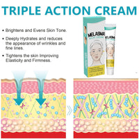 MEITREND Melasma Treatment For Face,Dark Spot Remover for Face & Body, Pigmentation Removal Cream,Corrector For Age Spots Sun Spots Freckles Melasma Brown Spots,Freckle Removal Cream