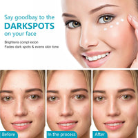 Shefave Dark Spot Remover For Face & Body, Pigmentation Removal Cream, Hyperpigmentation Treatment Melasma Cream - Reduces Dark Spots, Hyperpigmentation & Scars, Hydrates & Evens Skin Tone For Radiant Glow