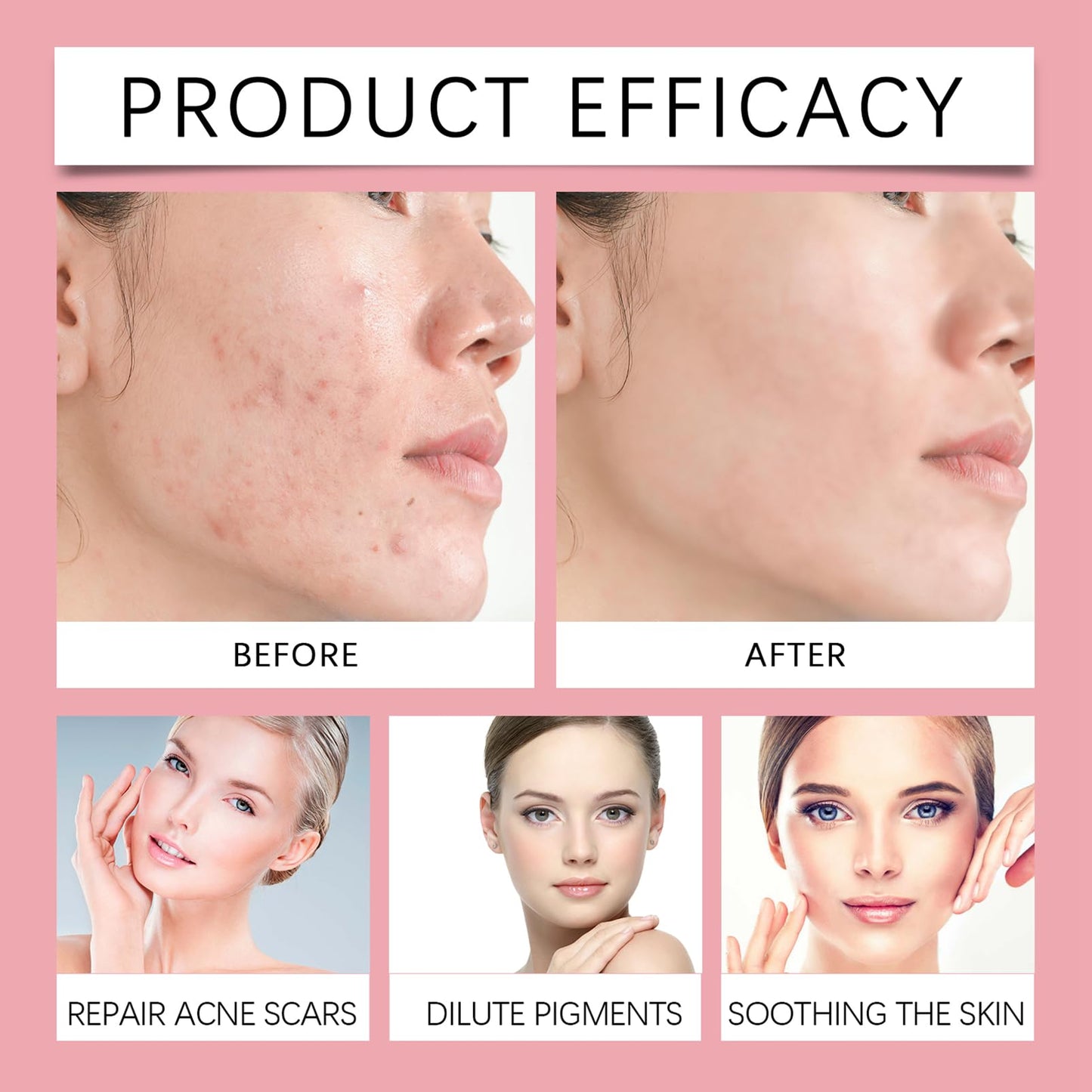 MEITREND Drying Lotion for Acne Treatment,Anti Acne Face Serum,Overnight Acne Drying Lotion,Spot Treatment,Pimple Lotio-n,Dry Out Blemishes & Pimple Reduce Redness