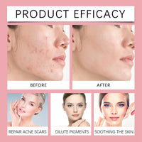MEITREND Drying Lotion for Acne Treatment,Anti Acne Face Serum,Overnight Acne Drying Lotion,Spot Treatment,Pimple Lotio-n,Dry Out Blemishes & Pimple Reduce Redness