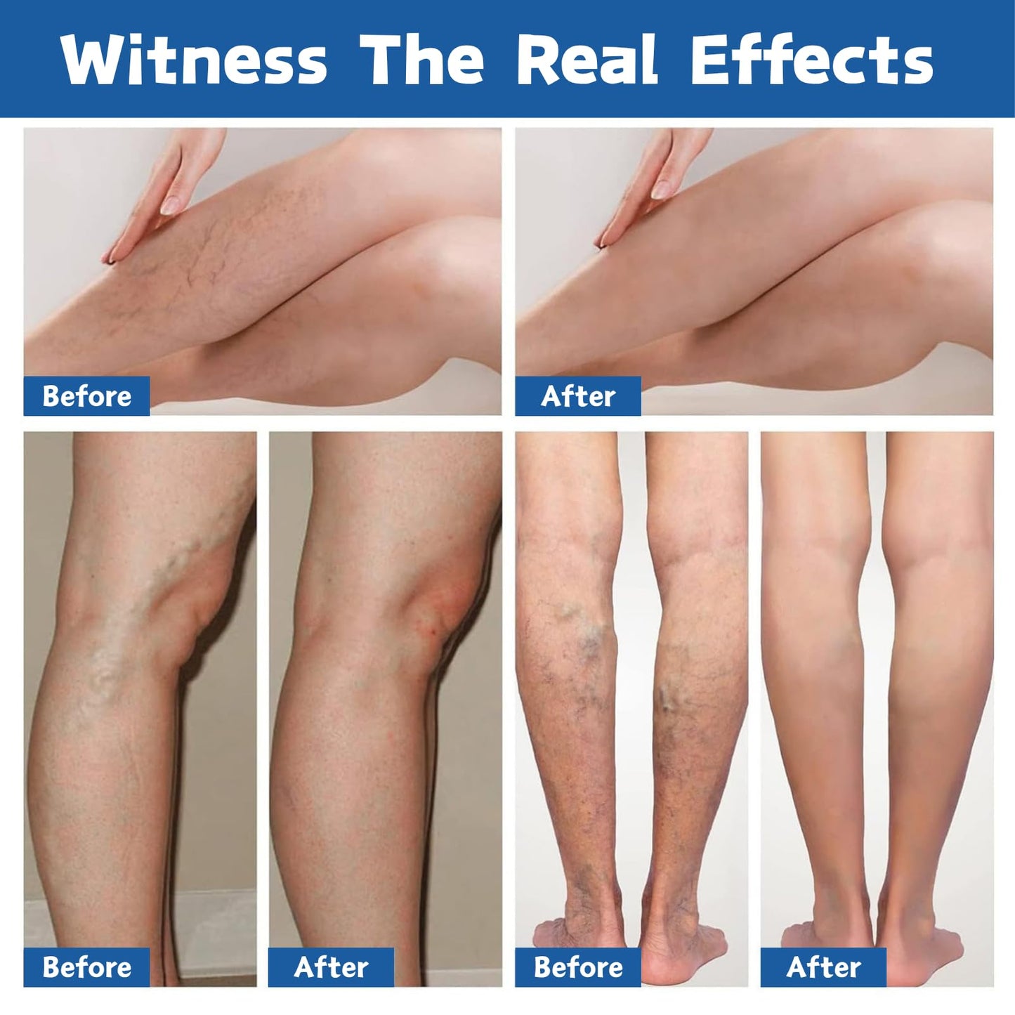 2PCS Va-ricose V-eins Cream, Va-ricose V-eins Treatment for Legs, Herbal Balm to Reduce Swelling in Feet and Legs, Spider v-eins Repair Cream for Women & Men, Vegan Legs Swelling Relief, 20g × 2