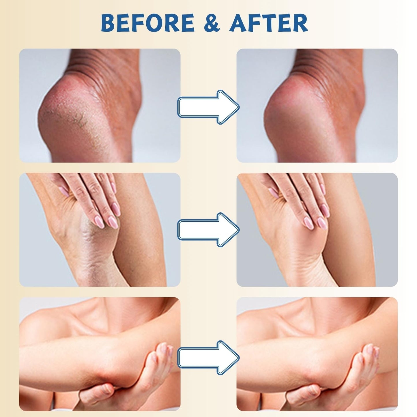 60% Urea Cream - Cracked Heel Repair Cream - Urea Foot Cream with Salicylic Acid, Aloe Vera- Foot Cream for Cracked Heels and Dry Skin - Skin Care for Foot Moisturiser (3PCS)