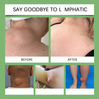 Lym/phatic De/tox Herbal Cream,Anti-Swelling Lotion for Neck Armpit,Lym/phatic Cream,Lymp/hatic Drainage Anti Ce/llulite Cream,An/ti Swelling Cr/eam,Skin Care Cre/am,Massage Cre/am for Neck Underarm