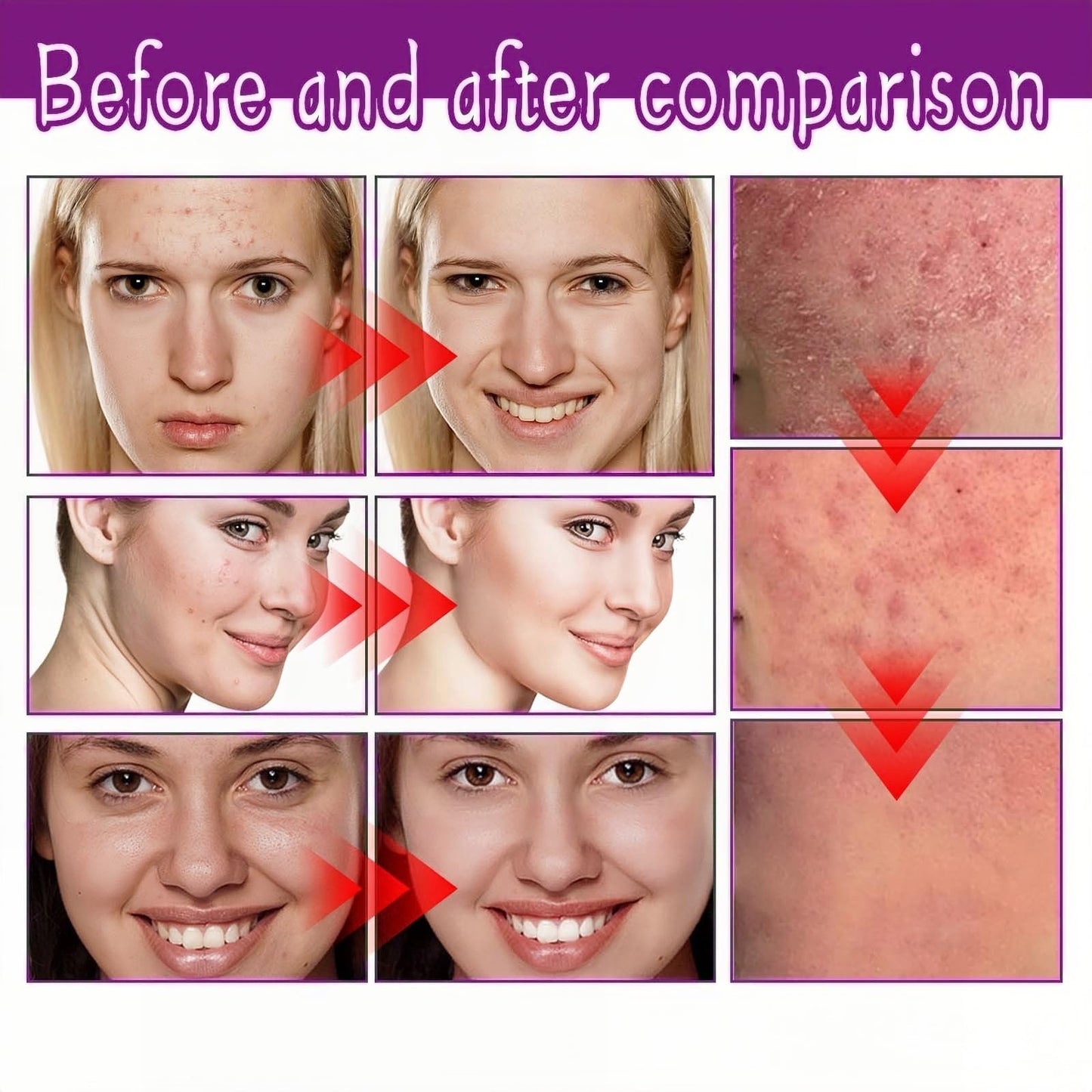 Acid Face Cream,Acid 12% Facial Serum Cream,Acne Treatment for Face,Skincare with Niacinamide & Vitamin C,Acne Scar Removal Cr/eam Night Serum for Face,Dark Spot Serum Crea/m,Acne Moisturiser,20g