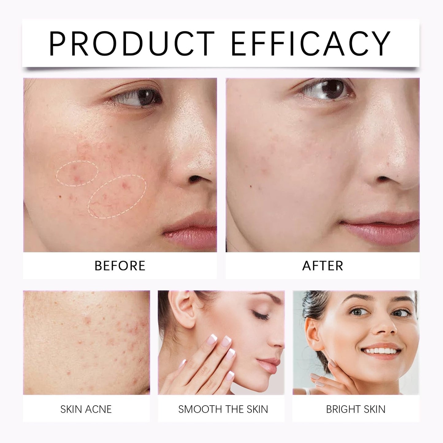 Acid Face Cream,Acid 12% Facial Serum Cream,Acne Treatment for Face,Skincare with Niacinamide & Vitamin C,Acne Scar Removal Cr/eam Night Serum for Face,Dark Spot Serum Crea/m,Acne Moisturiser,20g