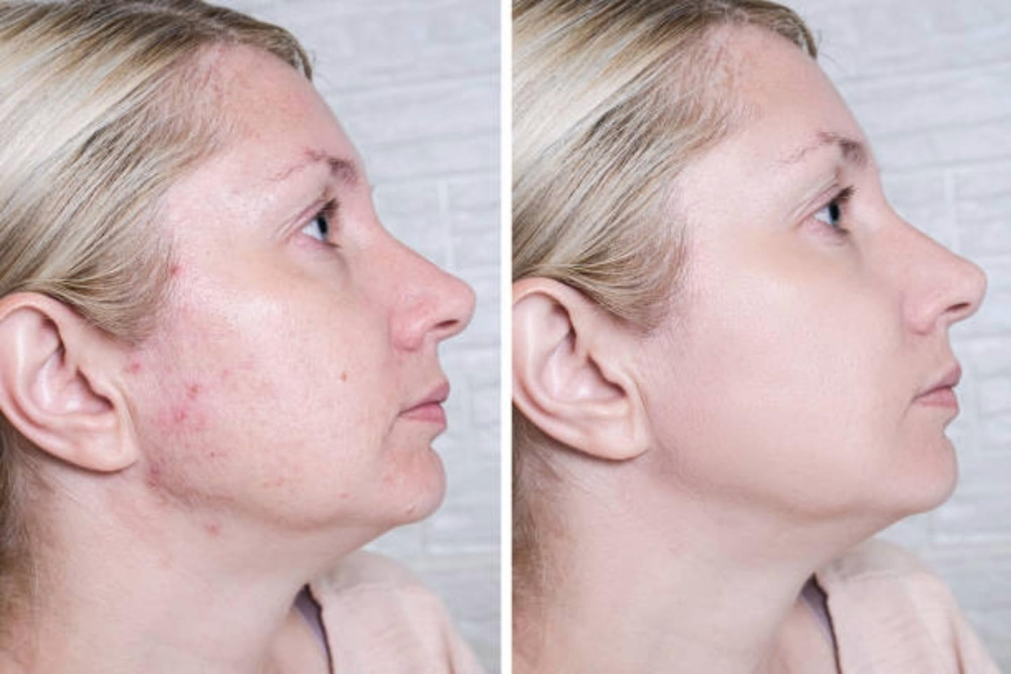 Rapid Acne Scar Treatment Cream - 24-Hour Fast Spot Reduction, Anti Acne Formula, Sensitive Skin Safe, Includes Fast Acne Scar Removal, Moisturiser, Deep Pore Cleansing - 30ml