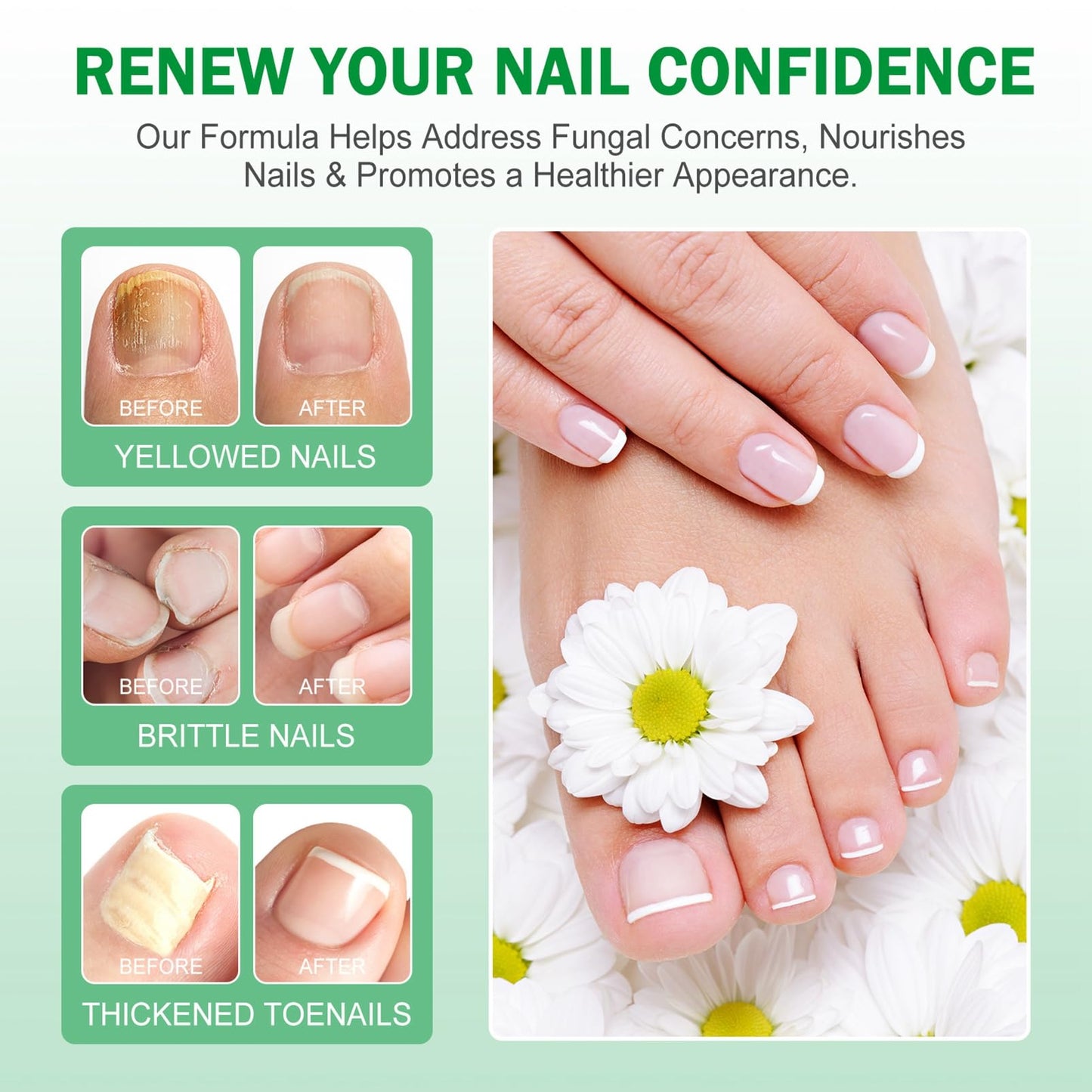 Tea Tree and Ginger Nail Fungus Treatment, Tea Tree Oil for Nail Fungus, 7 Days Fungal Nail Treatment for Toenail, Cuticle Care Oil, Nail Strengthener for Damaged Nails, Ginger Nail Serum