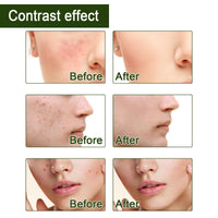 50g Salicylic Acid Acne Cream,3% BHA Spot Cream for Acne,Anti Redness Crea-m for Face,Ac-ne Scar Removal Cre-am,Pimple Cre-am for Redness,Moisturizing Face Cr-eam for Women,Dark Spot Remover for F-ace