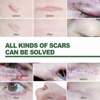 OuXing Wound Healing Oint-Ment,Relieve Skin Abrasions,Natral Healing Cream,Promote Skin HEA/ling Cream,Scab He/aling Cr/eam,Wo/und Cre/am Fade Scars,Wo/und He/aling Crea/m,Body Cre/am,WOU/nd Protection