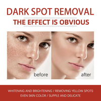 Kojic Acid Cream,Dark Spot Remover for Face,Skin Lightening Cream for Anti Aging,Dark Spot Correcting Glow Serum,Face Moisturizer for Women,Pigmentation Removal Cream,Freckle Removal Cream,Dark Spots