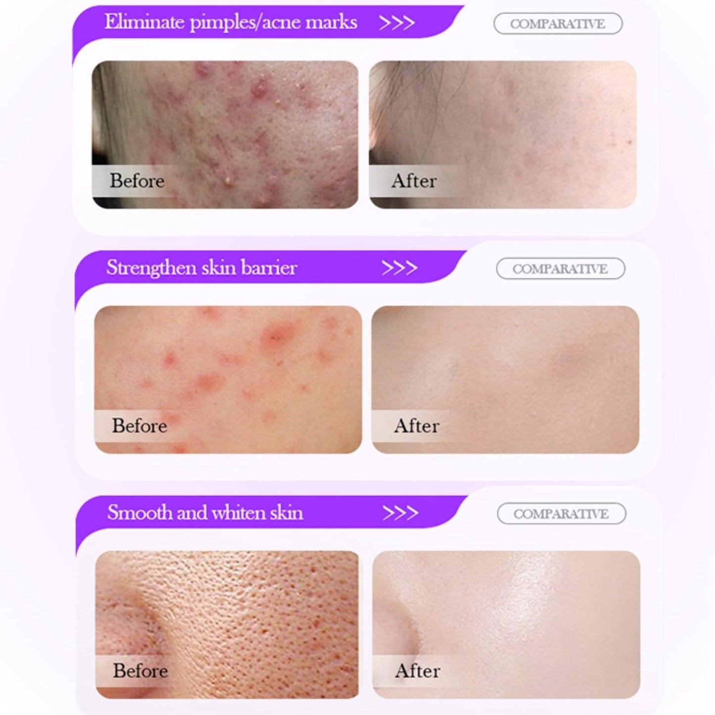 Cureluxe 12% Acid Repair Pimple Facial Serum Cream,Day and Night Repair Spot Face Serum Cream,Removes Acne,Redness, Fade,Dark Spots Correcting Face Moisturiser,Vitamin C & Niacinamide Ser-um Acne Creams