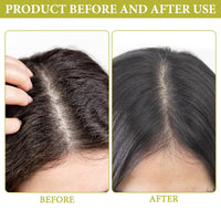 4 PCS Dandruff Comb Scalp Comb Psoriasis Comb 2 Hollow Tooth Comb with 2 Scalp Brush for Fine Hair and for Thick Hair for Removing Fleas Lice Dandruff and Tangled Hair