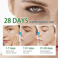 QinZiEn Anti-Hyperpigmentation Cream,Cream for Hyperpigmentation Treatment,Anti Aging Face Cre/am,Moisturiser Face Women,Dark Spot Remover,Wrinkle Filler Face Moisturiser,Intense Face Moisturiser 30g