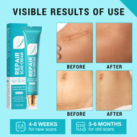 Benaewa 2 Pcs Scar Cream, Scar Removal Cream for Stretch Mark, Keloid Bump