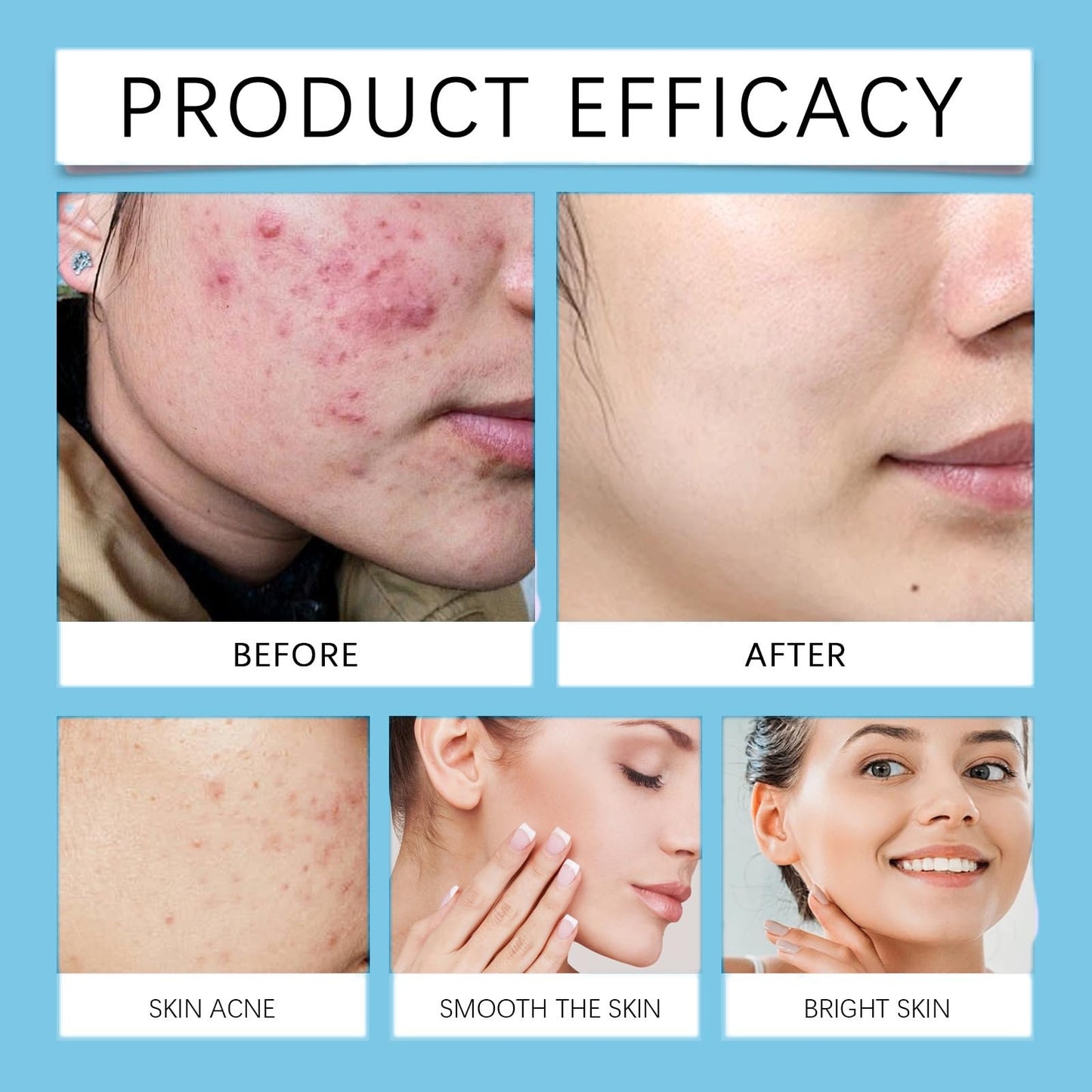 Xunzhi Acne Control Cream for Face,Acne Treatment Gel,A-cne Treatment,A-cne Face Cream,Ac-ne Gel Fast Absorbing Spot T-reatment,Anti Ac-ne F-ace C-ream,Acn-e C-ream for F-ace,Fa-ce Acn-e T-reatment
