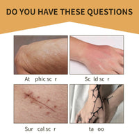 6PCS Concealer Sticker,Invisible Scar & Tat/too Cover-Up Patch,Waterproof Tat/too Cover Up Tape Breathable Scar Patches Ultra Thin Invisible Patch Concealer Sticker,Silicon Sc-ar Sheet