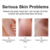 Strawberry Legs Treatment - Exfoliates & Moisturizes for Smooth Skin. Body Lotion for Rough, Uneven Texture Body Cream