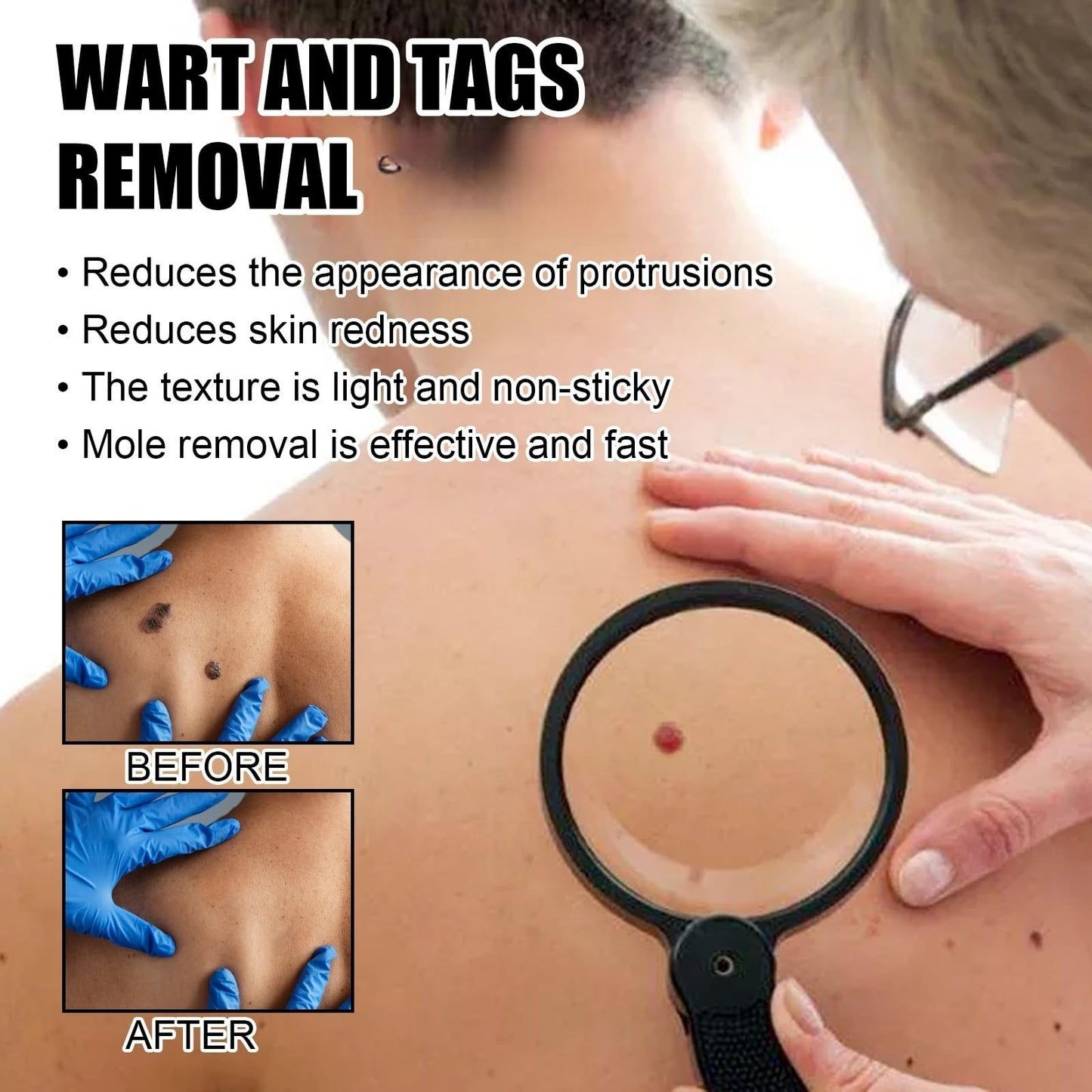 Jinjiar 2PCS Wart Remover Pen,Skin Wart Remover,Fast-Acting Wart Removal,Wart Freeze Removal,Foot & Hand Wart Strong Remover,Mole Remover,Natural Wart Re-Mover,Wart Re-Mover for Face,Flat Wa-rt Remover
