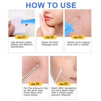 100pcs Blackhead Blemish Remover with Acne Spot Remover Pin, Disposable Acne Pimple Popper Needle, Pimple Needles, Professional Whitehead Acne Blackheads Remover Tools for Beauty Salon Home
