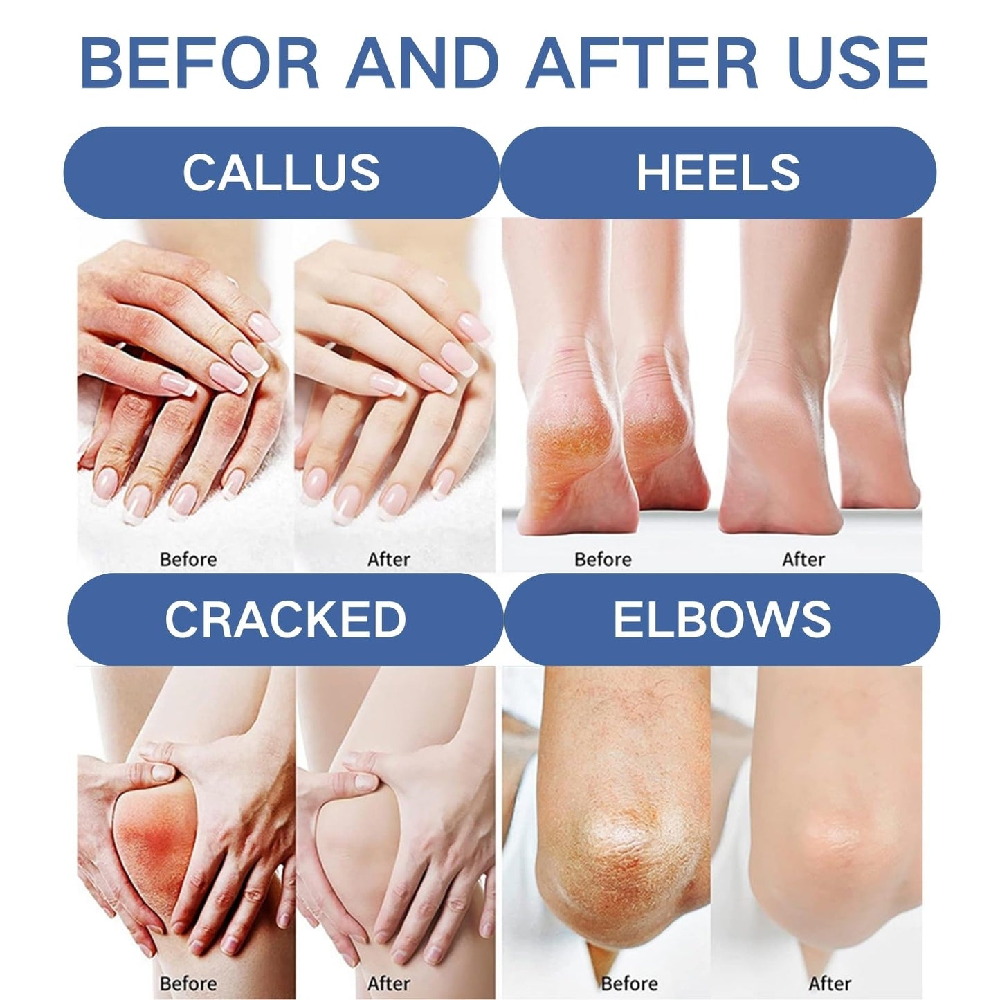 Cureluxe Urea Cream 60 Percent for Feet,60% Urea Foot Cream with Salicylic Acid,Foot Cream for Cracked Heels and Dry Skin,Cracked Heel Repair Cream,Deeply Moisturizing & Nourishing Foot Moisturiser,Heel Balm