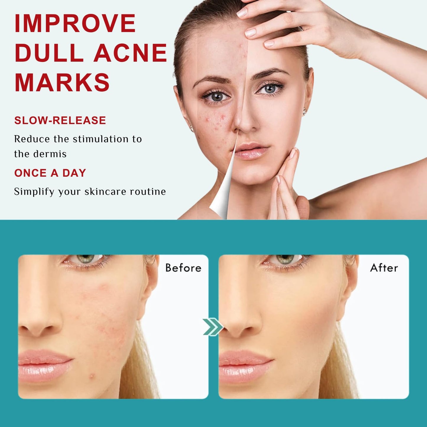 Acne Treatment Cream – Fast Acting Spot Treatment for Face - Blemish Control Cleanser Reduces Pimples, Blackheads & Blemishes - Gentle Skin Care for Oily & Acne-Prone Skin, 40g (2 Value Packs)