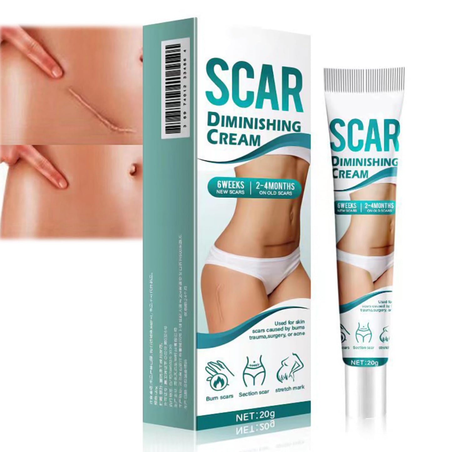 AuraBeen Scar Cream for Face & Body - Assists in Enhancing The Look of Stretch Marks, C - Section Scars, Surgical Scars - Suited for Old & New Scars - Facilitates Skin Restoration