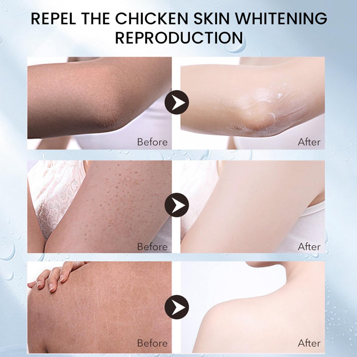 Strawberry Legs Treatment Body Cream,Keratosis Pilaris Cream Treatment with Vitamin E and Urea,Skin Exfoliating Repair Cream for Chicken Skin Treatment,Eliminates Strawberry Spots(30G)