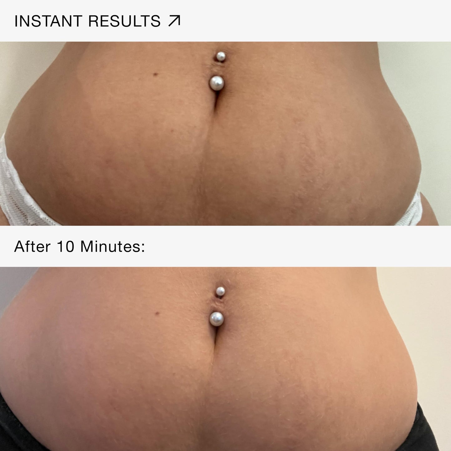 MULTI-AWARD-WINNING Stretch Mark Reduction for Men & Women – Peptide and Vitamins Pregnancy Cream Reduces Stretch Marks, Improves Elasticity and Firmness – Stretch Mark Removal Cream