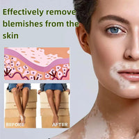 Yoowan Treatment Cream,Freckle Removal Cream,Freckle Remover,Skin Barrier Repair Cr-Eam,Effectively Alleviate The White Blemishes On The Skin,Daily Repair Balm,Deep Moisturizing For Dry Face And Body
