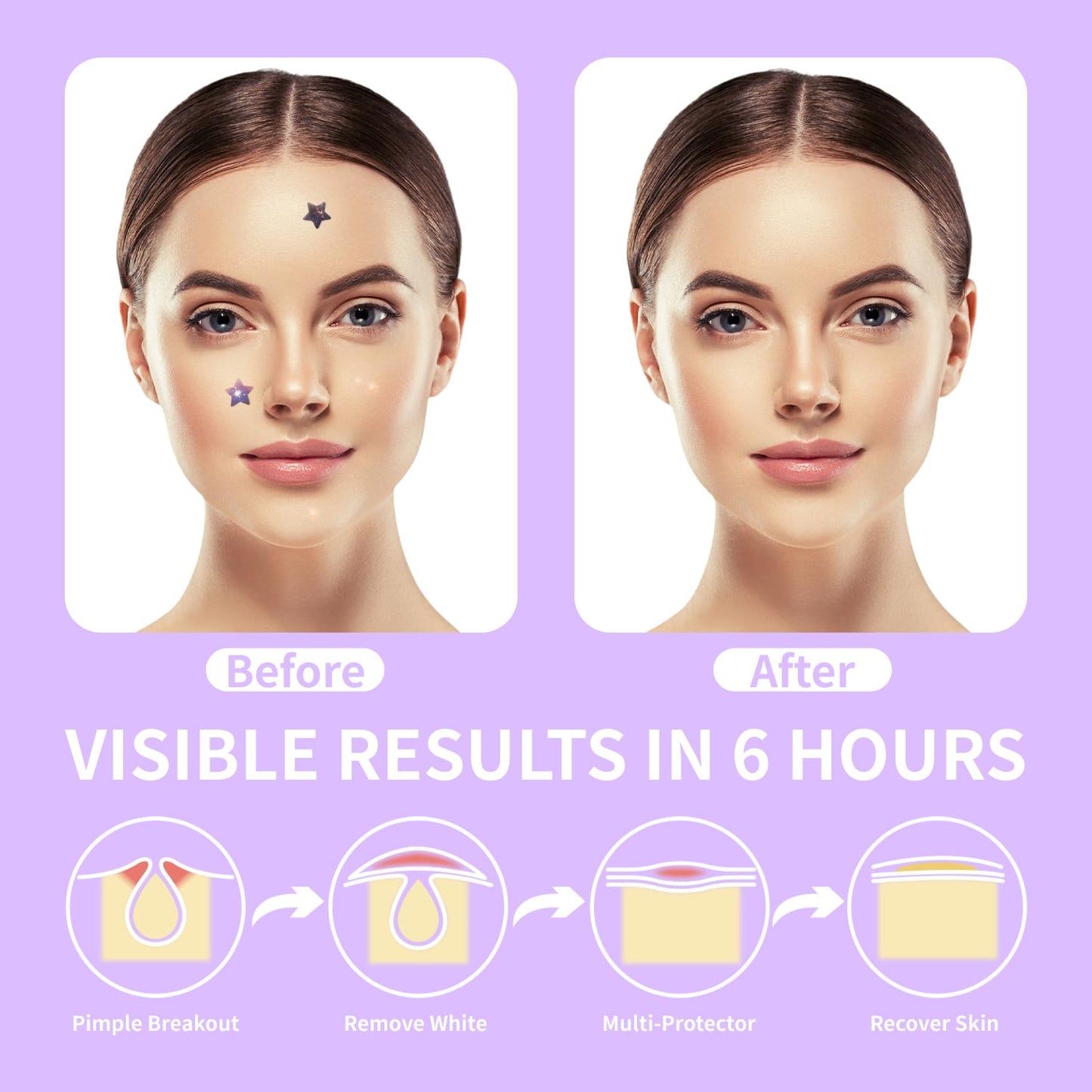 AUSLKA Pimple Patches (300 Patches),Hydrocolloid Patches,Spot Stickers with Star Shaped,Facial Stickers,Pimples, Blemishes, Zits for Face