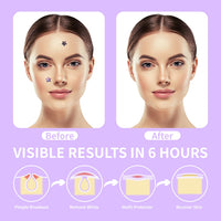 AUSLKA Pimple Patches (300 Patches),Hydrocolloid Patches,Spot Stickers with Star Shaped,Facial Stickers,Pimples, Blemishes, Zits for Face