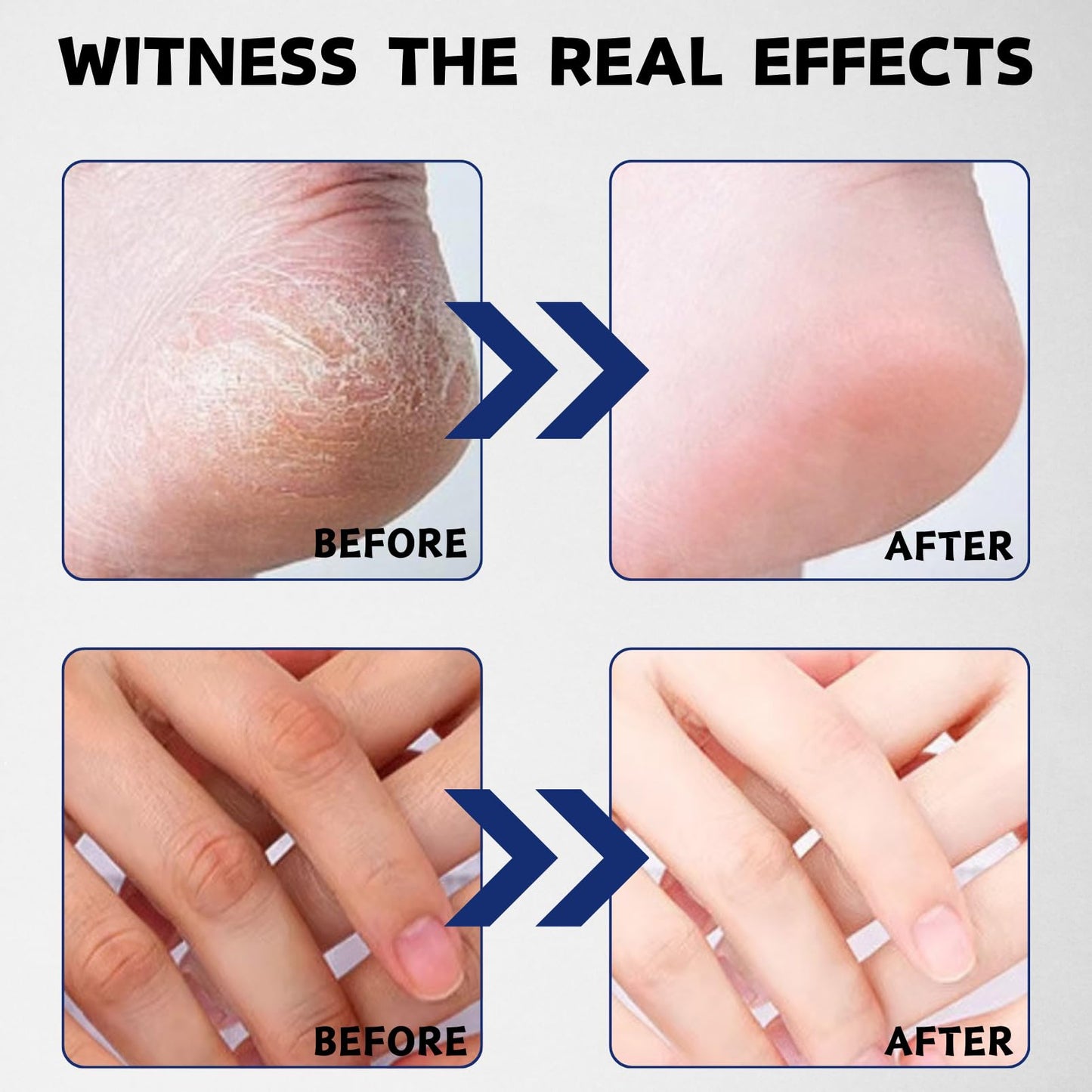 ISBEAUSOLS 40% Urea Cream, Urea Foot Cream for Cracked Heels And Dry Skin, Foot Care for Deeply Moisturizing & Nourishing, Urea Cream Softens Hand & Foot Skin, Foot Moisturiser for Women & Men, 150g