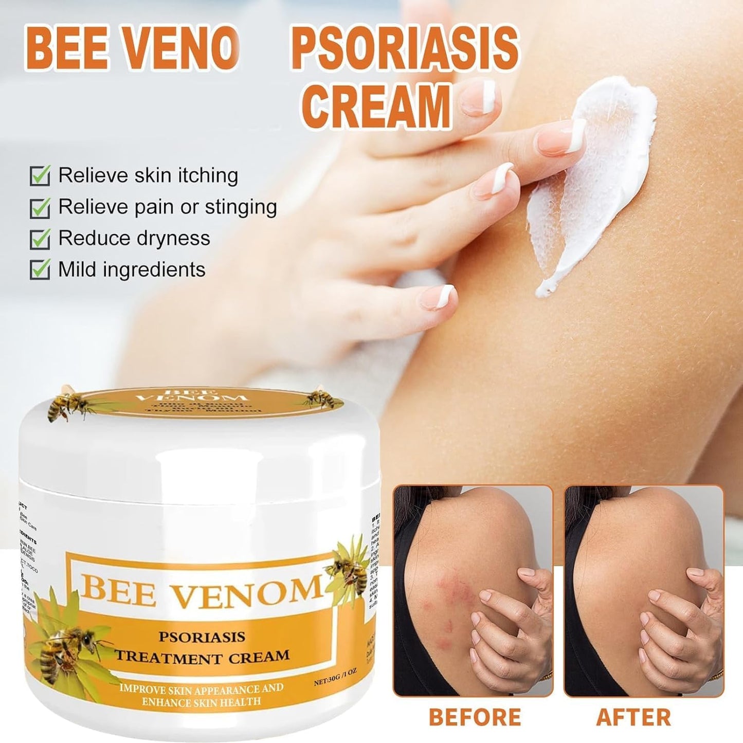 Generic 2PCS 30g Bee Venom Psoriasis Cream, Cvreoz Bee Venom Psoriasis Cream, New Zealand Bee Venom Cream, Fast-Acting Relief Bee Venom Cream Psoriasis Treatment Cream, Soothing Psoriasis Cream(30g*2pcs)