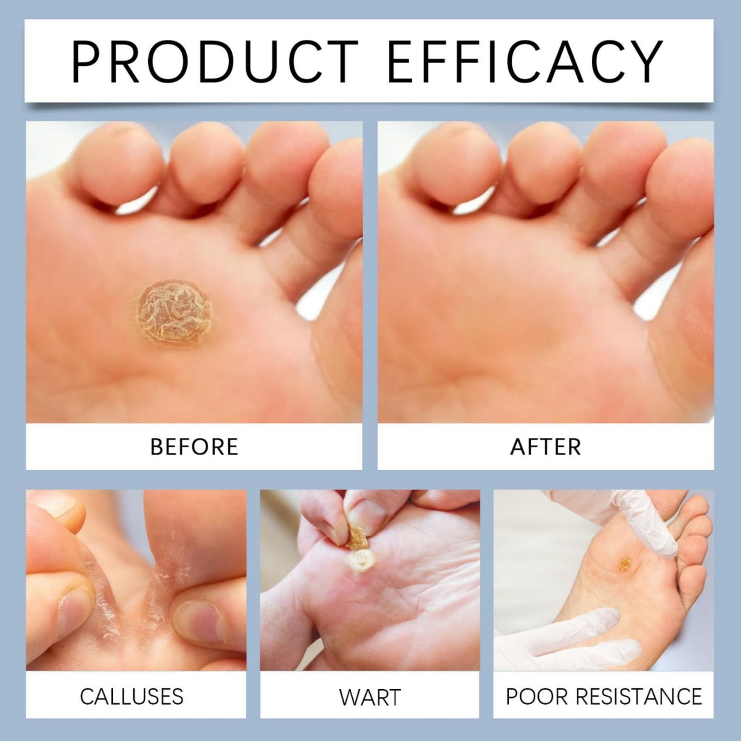 24pcs Corn Remover for Feet and Hand,Wart Remover,Effective Deep Verruca Removal Pads Patches,Corn Callus Remover for Feet,Verruca Treatment,Wart Treatment Effective Way,Pain Relief,Repair Skin