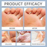 24pcs Corn Remover for Feet and Hand,Wart Remover,Effective Deep Verruca Removal Pads Patches,Corn Callus Remover for Feet,Verruca Treatment,Wart Treatment Effective Way,Pain Relief,Repair Skin