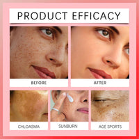 MINSHZEE Freckle Removal Cream - Removes facial dark spots, Dark Spot Remover with Niacinamide and Vitamin C, Improves dull skin (1 piece)