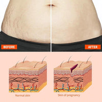 EliiSkinn Stretch-Marks, Scar Treatment Oil - Helps Reduce The Appearance Of Stretch Marks & Scars -Non-greasy Moisturizer Lotion- Improves Appearance of Stretch Marks, Scars, and Uneven Skin Tone - 125ml