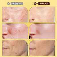 Yoowan Rapid Skin Repair Cream,Skin Ta/g Remover,Anti Wrinkle Face Cream,Sk-In Lightening Cre-Am,Blemish Cre-Am,Intense Hydration,Redness Relief Moisturizer,Comprehensive Bee Ven-Om Balm For Dry,Sensitive