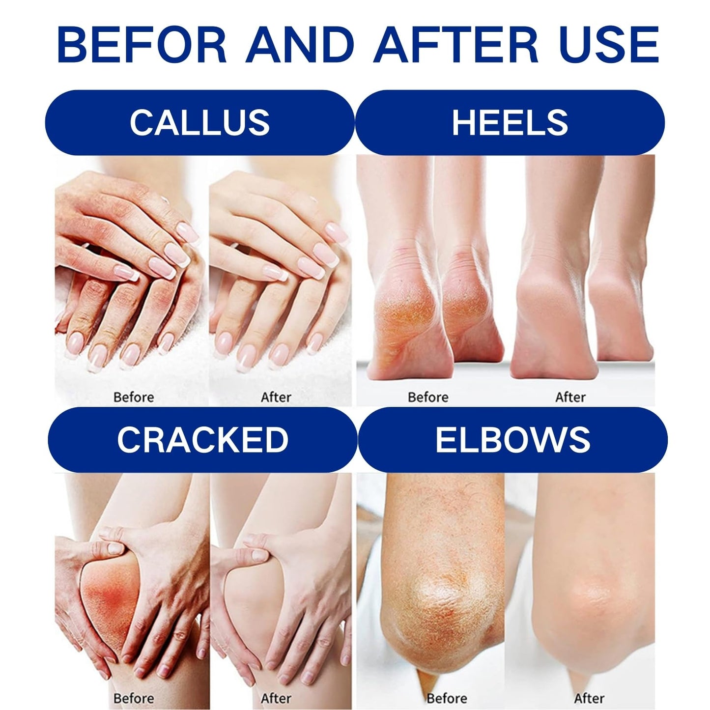 Cureluxe 42% Urea Cream with 2% Salicylic Acid - Foot Moisturiser for Dry,Rough,Cracked Heels - Gentle Exfoliation Urea Foot Cream - Urea Cream 42 Percent for Feet - Multi-Purpose Cracked Heel Repair Cream